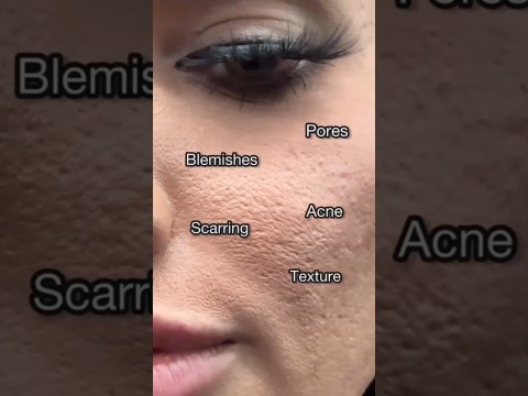 Best Serum for open Pores, Acne & Scarring | The Ordinary Niacinamide 10% Review Best Serum for open Pores, Acne & Scarring | The Ordinary Niacinamide 10% Review