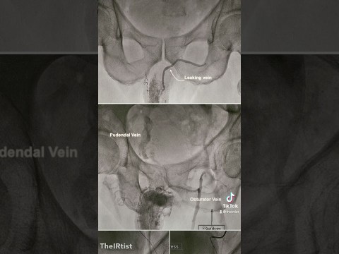 Treatment of erectile dysfunction caused by Venous leakage by interventional coil embolization Treatment of erectile dysfunction caused by Venous leakage by interventional coil embolization