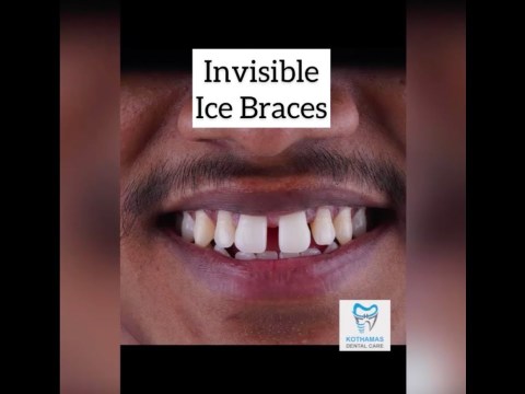 How braces are put on – Crystal clear braces #shorts How braces are put on – Crystal clear braces #shorts