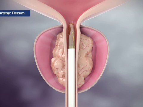 Mayo Clinic Minute: Steam treatment for enlarged prostate Mayo Clinic Minute: Steam treatment for enlarged prostate
