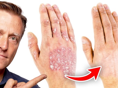 The #1 Best Remedy for Eczema The #1 Best Remedy for Eczema