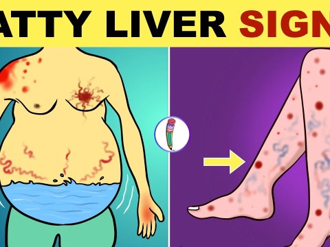 Fatty Liver Symptoms | Early Signs of Fatty Liver Disease | Non Alcoholic Fatty Liver Disease Fatty Liver Symptoms | Early Signs of Fatty Liver Disease | Non Alcoholic Fatty Liver Disease