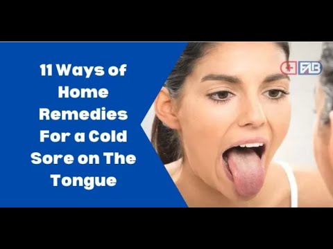 11 Ways of Home Remedies for a cold sore on the tongue First Aid Buy 11 Ways of Home Remedies for a cold sore on the tongue First Aid Buy
