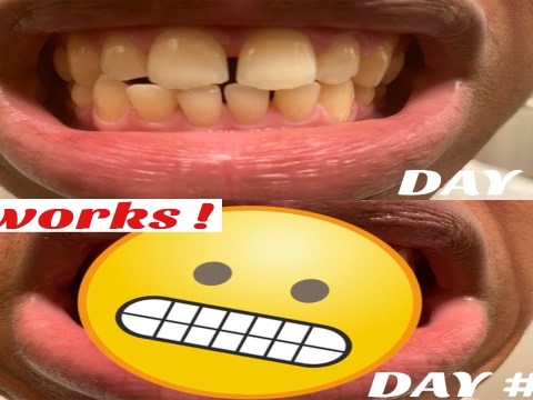 Snow Teeth Whitening Review – 30 Days results Snow Teeth Whitening Review – 30 Days results