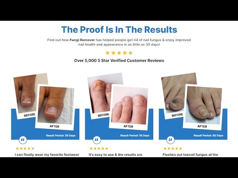 Nature's Remedy Fungi Remover Review Nature's Remedy Fungi Remover Review