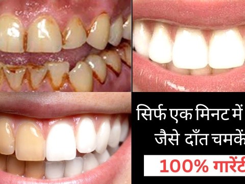 100% गारेंटी है toothpaste मे बस एक चीज मिला कर लगा लो दाँत मोती की तरह चमकने लगेंगे Teeth Whitening 100% गारेंटी है toothpaste मे बस एक चीज मिला कर लगा लो दाँत मोती की तरह चमकने लगेंगे Teeth Whitening