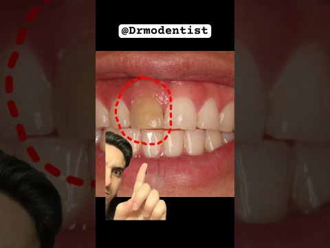 individual upper front tooth discoloration! Dentist reacts #teethwhiteningtips #teethwhiteningremedy individual upper front tooth discoloration! Dentist reacts #teethwhiteningtips #teethwhiteningremedy