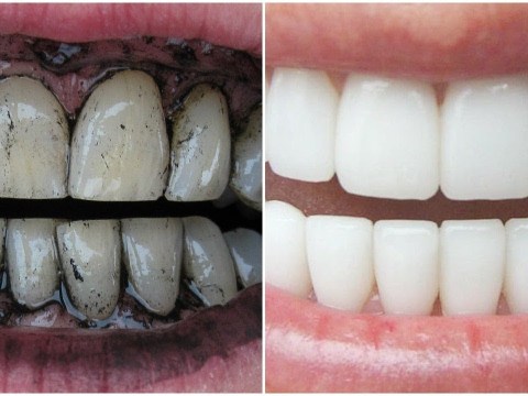 3 Way to Whiten Your Yellow Teeth Naturally 3 Way to Whiten Your Yellow Teeth Naturally
