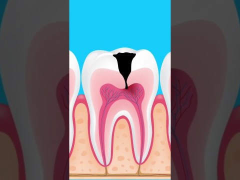 What happens if tooth decay is left untreated What happens if tooth decay is left untreated