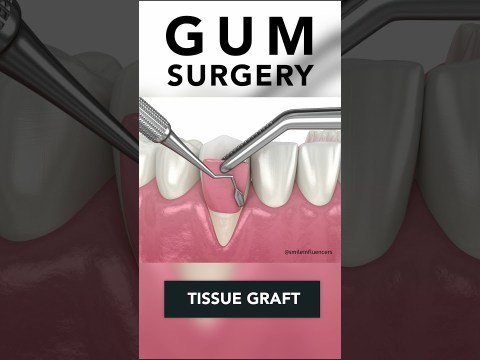 Receding Gums Surgery Receding Gums Surgery