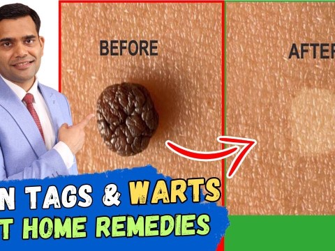 Skin Tags And Warts Will Disappear in 24 Hours – Dr. Vivek Joshi Skin Tags And Warts Will Disappear in 24 Hours – Dr. Vivek Joshi