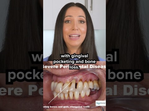 if you have gum disease, do this! #shorts if you have gum disease, do this! #shorts