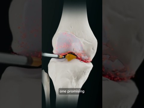 Platelet rich plasma treatment for knee arthritis Platelet rich plasma treatment for knee arthritis