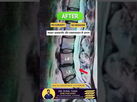 L4 L5 disc herniation treatment without surgery #drsuniltank #physiopoint #backpain #sciatica L4 L5 disc herniation treatment without surgery #drsuniltank #physiopoint #backpain #sciatica