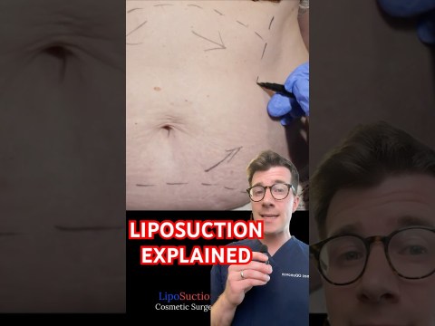 Doctor explains LIPOSUCTION for weight loss #shorts Doctor explains LIPOSUCTION for weight loss #shorts
