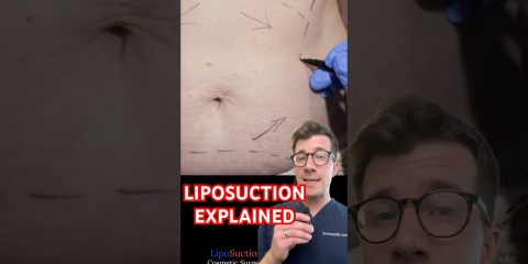 Doctor explains LIPOSUCTION for weight loss #shorts Doctor explains LIPOSUCTION for weight loss #shorts