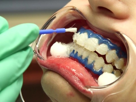 Shatkin iSmile Teeth Whitening Shatkin iSmile Teeth Whitening