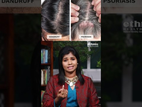 Scalp Psoriasis Treat Naturally ! #health #tips #healthy #homeremedies #cure #hair #scalptreatment Scalp Psoriasis Treat Naturally ! #health #tips #healthy #homeremedies #cure #hair #scalptreatment
