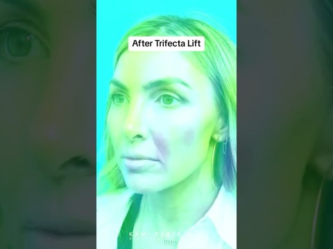 Treatment for Eye Bags that Concealer Won't Cover | Dr. Kami Parsa, M.D. Treatment for Eye Bags that Concealer Won't Cover | Dr. Kami Parsa, M.D.