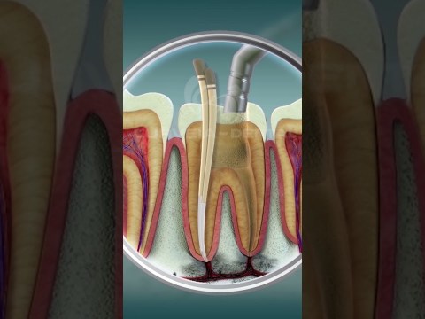Root Canal Treatment | Curveia Dental I RCT Root Canal Treatment | Curveia Dental I RCT