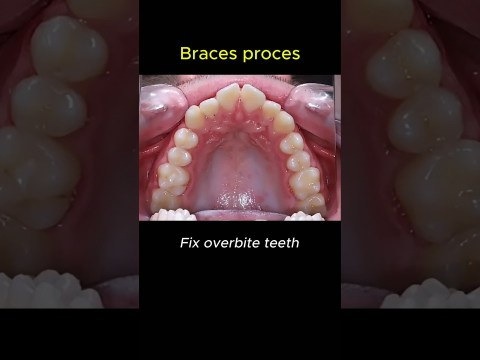 How to fix overbite teeth? Braces process transform #dentist #braces #orthodontist How to fix overbite teeth? Braces process transform #dentist #braces #orthodontist