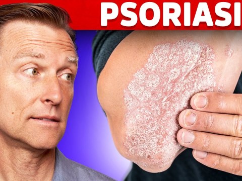 Psoriasis Treatment – The Best 3 Remedies for Psoriasis – Dr.Berg Psoriasis Treatment – The Best 3 Remedies for Psoriasis – Dr.Berg