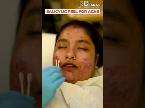 Salicylic Peel REVOLUTIONIZES Acne Treatment! Salicylic Peel REVOLUTIONIZES Acne Treatment!