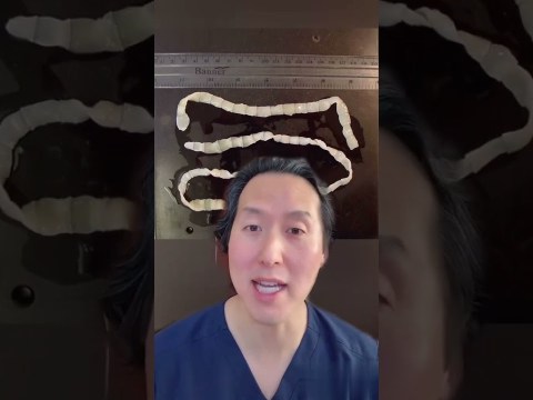 Weight Loss Due To Tapeworms?!?! It’s True #shorts Weight Loss Due To Tapeworms?!?! It’s True #shorts