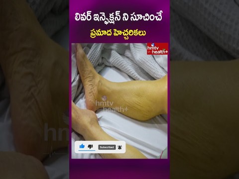 లివర్ ఇన్ఫెక్షన్ ని సూచించే ప్రమాద హెచ్చరికలు#Liver infection #healthtips#shorts #hmtvhealthplus లివర్ ఇన్ఫెక్షన్ ని సూచించే ప్రమాద హెచ్చరికలు#Liver infection #healthtips#shorts #hmtvhealthplus