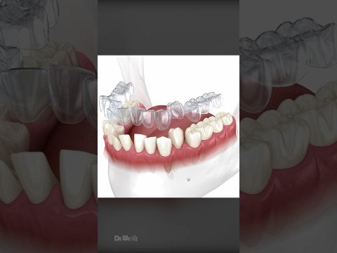 How Does Invisalign Aligners Work To Straighten Teeth How Does Invisalign Aligners Work To Straighten Teeth