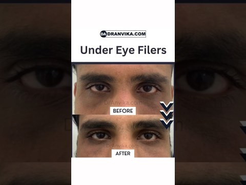 Under Eye Fillers treatment #shorts Under Eye Fillers treatment #shorts