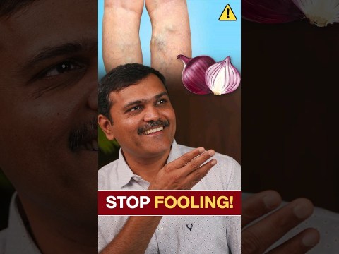Onion Magic for VARICOSE Veins? The Shocking TRUTH! Onion Magic for VARICOSE Veins? The Shocking TRUTH!