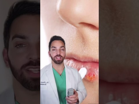 COLD SORES ON THE LIPS? #shorts COLD SORES ON THE LIPS? #shorts