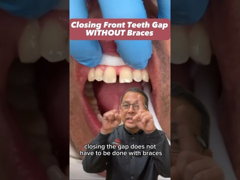 Fixing Front Teeth Gap in ONE Appointment EXPLAINED | In Office to Hands On Dental Training #shorts Fixing Front Teeth Gap in ONE Appointment EXPLAINED | In Office to Hands On Dental Training #shorts