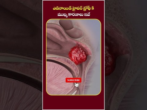 పిల్లల్లో జలుబుకు కారణాలు | Adenoid Hypertrophy in Telugu | Socialpost Health | #shorts #ytshorts పిల్లల్లో జలుబుకు కారణాలు | Adenoid Hypertrophy in Telugu | Socialpost Health | #shorts #ytshorts