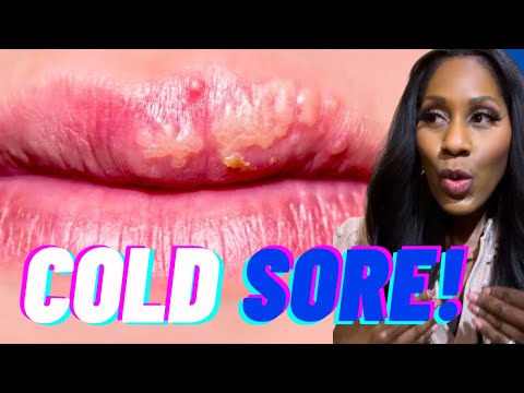 GET RID OF COLD SORES FAST! Plus, Are Cold Sores CONTAGIOUS? What Causes Cold Sores? A Doc Explains GET RID OF COLD SORES FAST! Plus, Are Cold Sores CONTAGIOUS? What Causes Cold Sores? A Doc Explains