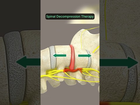 Spinal Decompression for Lower Back Pain and Sciatica #spinaldecompression #sciatica #herniateddisc Spinal Decompression for Lower Back Pain and Sciatica #spinaldecompression #sciatica #herniateddisc