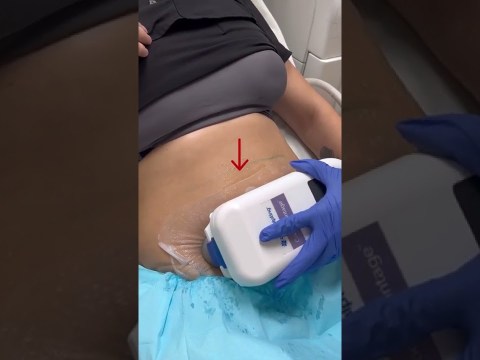 How to freeze your fat with CoolSculpting? | Dr. Swati Kannan #shorts How to freeze your fat with CoolSculpting? | Dr. Swati Kannan #shorts
