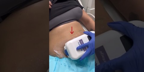 How to freeze your fat with CoolSculpting? | Dr. Swati Kannan #shorts How to freeze your fat with CoolSculpting? | Dr. Swati Kannan #shorts