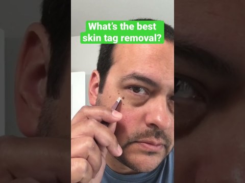 Best Skin Tag Removal At Home #shorts Best Skin Tag Removal At Home #shorts