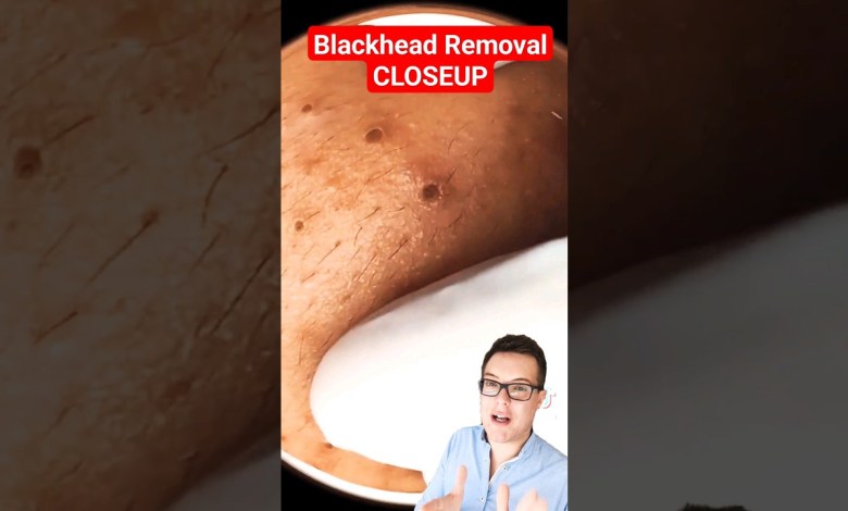 CRAZY CLOSEUP BLACKHEAD REMOVAL #shorts CRAZY CLOSEUP BLACKHEAD REMOVAL #shorts