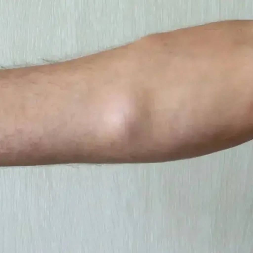 உங்கள் தோலின் கீழ் மென்மையான கட்டி? இது ஒரு லிபோமாவாக இருக்கலாம்: லிபோமாக்கள் பற்றி நீங்கள் தெரிந்து கொள்ள வேண்டியது இங்கே | – டைம்ஸ் ஆஃப் இந்தியா உங்கள் தோலின் கீழ் மென்மையான கட்டி? இது ஒரு லிபோமாவாக இருக்கலாம்: லிபோமாக்கள் பற்றி நீங்கள் தெரிந்து கொள்ள வேண்டியது இங்கே | – டைம்ஸ் ஆஃப் இந்தியா