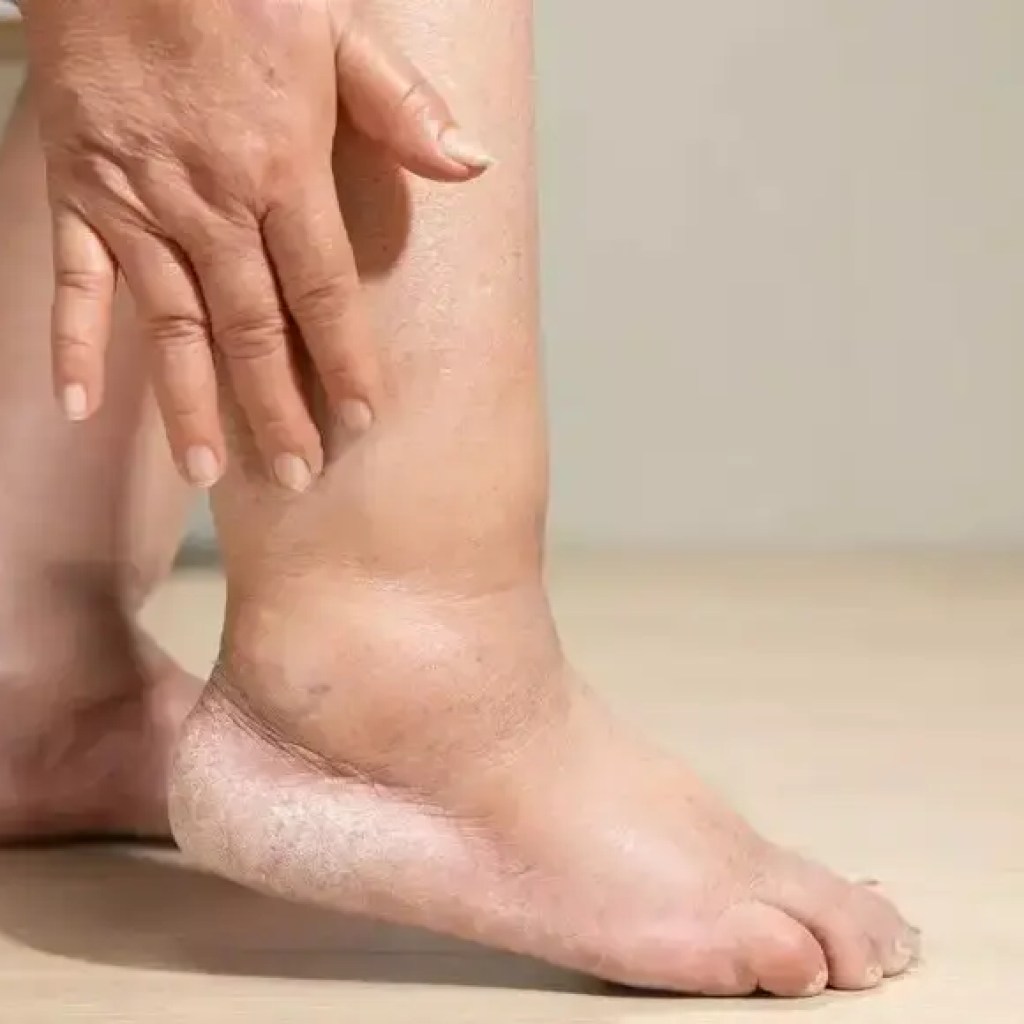 கணுக்கால் வீக்கம் என்பது இதய செயலிழப்புக்கான அறிகுறியாகும்: காரணங்கள், அறிகுறிகள் மற்றும் ஒரு மருத்துவரை எப்போது பார்க்க வேண்டும் | – டைம்ஸ் ஆஃப் இந்தியா கணுக்கால் வீக்கம் என்பது இதய செயலிழப்புக்கான அறிகுறியாகும்: காரணங்கள், அறிகுறிகள் மற்றும் ஒரு மருத்துவரை எப்போது பார்க்க வேண்டும் | – டைம்ஸ் ஆஃப் இந்தியா