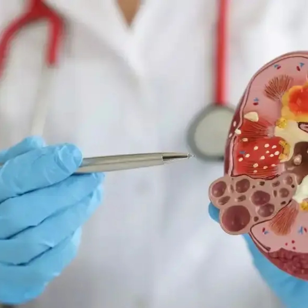 சிறுநீரக மாற்று அறுவை சிகிச்சைக்குப் பிறகு என்ன நடக்கும்? முன்னெச்சரிக்கை உதவிக்குறிப்புகள், சிக்கல்கள், மீட்பு ஆலோசனை மற்றும் பலவற்றை அறிந்து கொள்ளுங்கள் | – டைம்ஸ் ஆஃப் இந்தியா சிறுநீரக மாற்று அறுவை சிகிச்சைக்குப் பிறகு என்ன நடக்கும்? முன்னெச்சரிக்கை உதவிக்குறிப்புகள், சிக்கல்கள், மீட்பு ஆலோசனை மற்றும் பலவற்றை அறிந்து கொள்ளுங்கள் | – டைம்ஸ் ஆஃப் இந்தியா