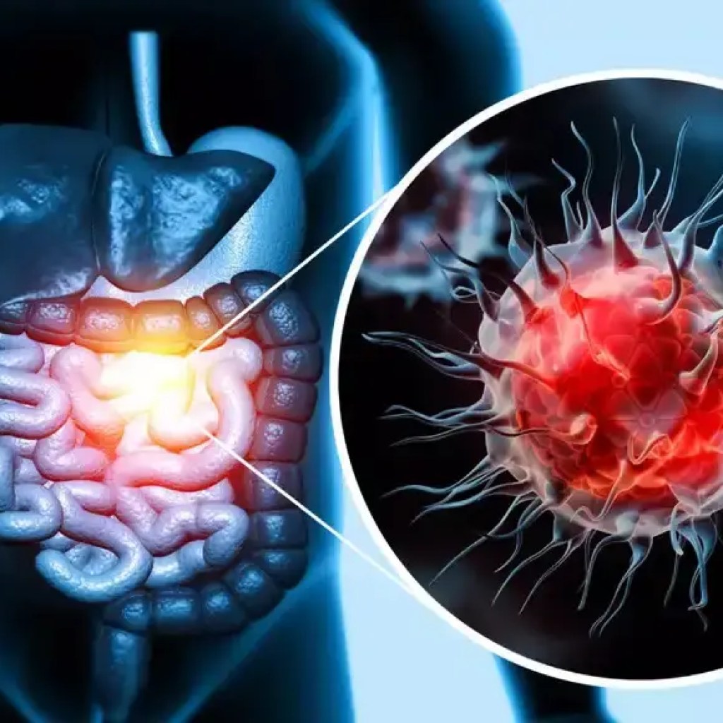 எடை இழப்பு திட்டத்தில்? உங்கள் உணவு உங்கள் பெருங்குடல் புற்றுநோய் அபாயத்தை உயர்த்தக்கூடும் | – தி டைம்ஸ் ஆஃப் இந்தியா எடை இழப்பு திட்டத்தில்? உங்கள் உணவு உங்கள் பெருங்குடல் புற்றுநோய் அபாயத்தை உயர்த்தக்கூடும் | – தி டைம்ஸ் ஆஃப் இந்தியா