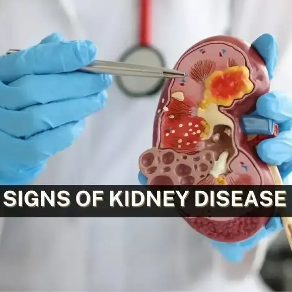 நீங்கள் புறக்கணிக்கக்கூடாத சிறுநீரக நோயின் 5 அமைதியான அறிகுறிகள் | – டைம்ஸ் ஆஃப் இந்தியா நீங்கள் புறக்கணிக்கக்கூடாத சிறுநீரக நோயின் 5 அமைதியான அறிகுறிகள் | – டைம்ஸ் ஆஃப் இந்தியா