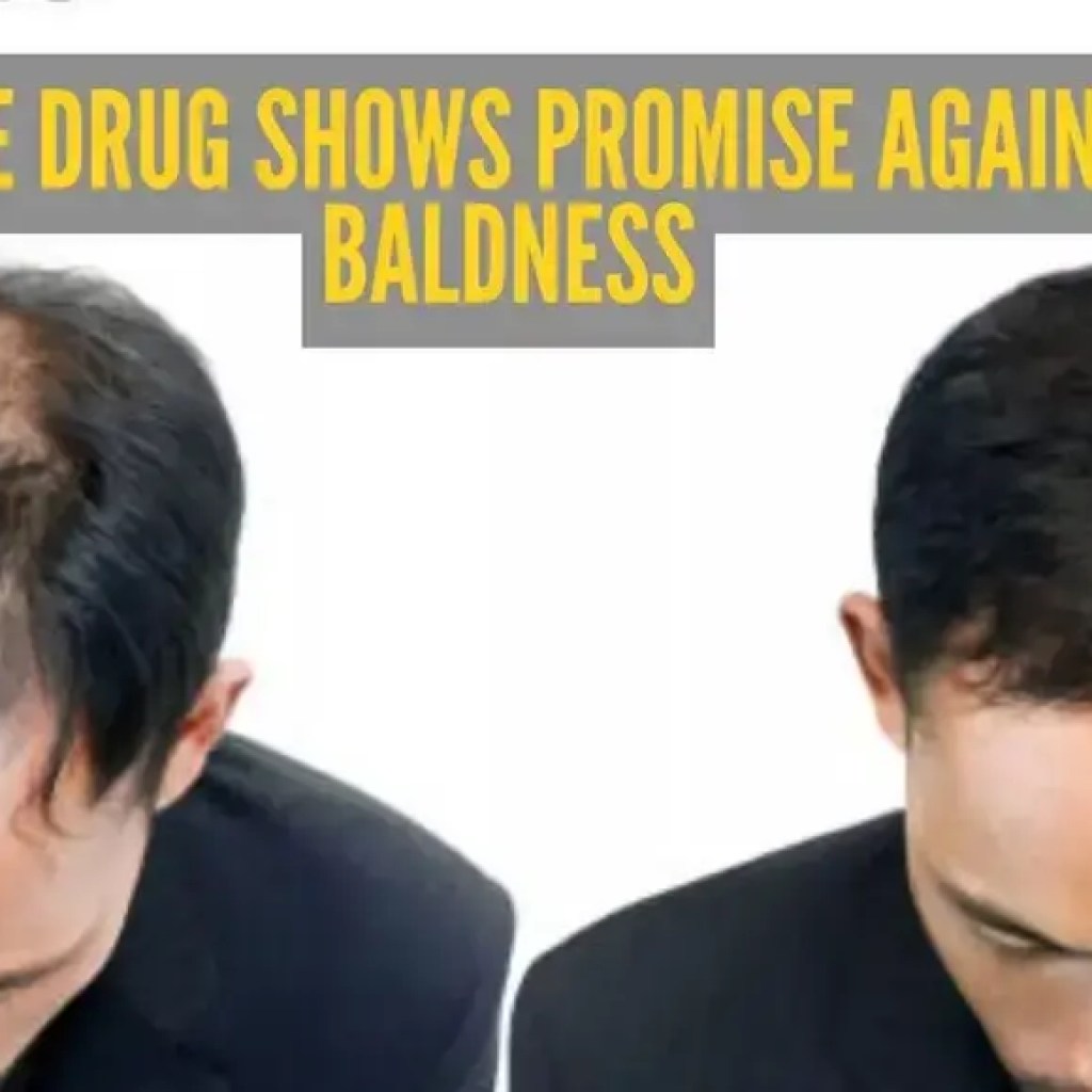 வழுக்கைக்கான சிகிச்சையை கண்டுபிடிப்பதில் திருப்புமுனை: பொதுவான முகப்பரு மருந்து ஆண்களின் வழுக்கை சிகிச்சையில் குறிப்பிடத்தக்க முடிவுகளைக் காட்டுகிறது | – டைம்ஸ் ஆஃப் இந்தியா வழுக்கைக்கான சிகிச்சையை கண்டுபிடிப்பதில் திருப்புமுனை: பொதுவான முகப்பரு மருந்து ஆண்களின் வழுக்கை சிகிச்சையில் குறிப்பிடத்தக்க முடிவுகளைக் காட்டுகிறது | – டைம்ஸ் ஆஃப் இந்தியா