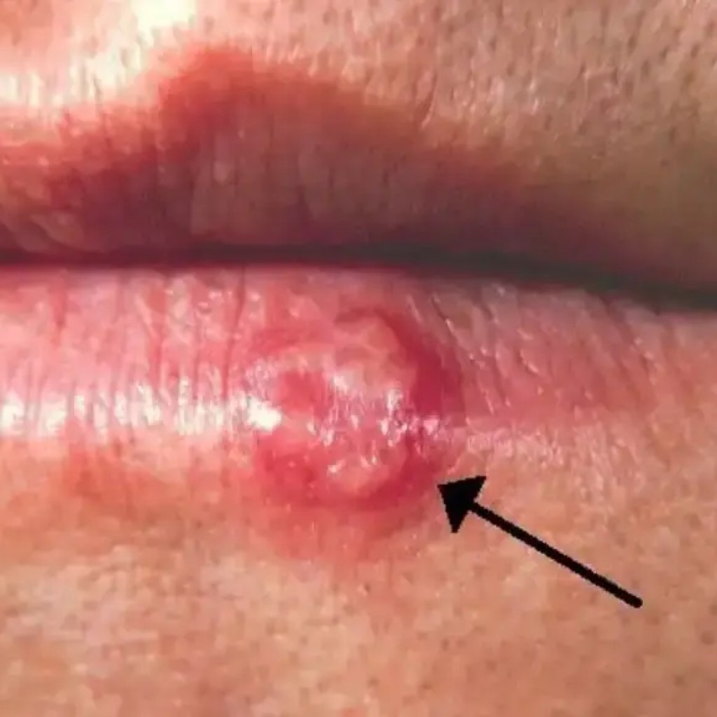 ஹெர்பெஸ் சிம்ப்ளக்ஸ் வைரஸ்: அதன் அறிகுறிகள், வெடிப்பு காரணங்கள், அது எவ்வாறு பரவுகிறது மற்றும் தொற்றுநோயை நிர்வகிப்பதற்கான குறிப்புகள் – டைம்ஸ் ஆஃப் இந்தியா ஹெர்பெஸ் சிம்ப்ளக்ஸ் வைரஸ்: அதன் அறிகுறிகள், வெடிப்பு காரணங்கள், அது எவ்வாறு பரவுகிறது மற்றும் தொற்றுநோயை நிர்வகிப்பதற்கான குறிப்புகள் – டைம்ஸ் ஆஃப் இந்தியா