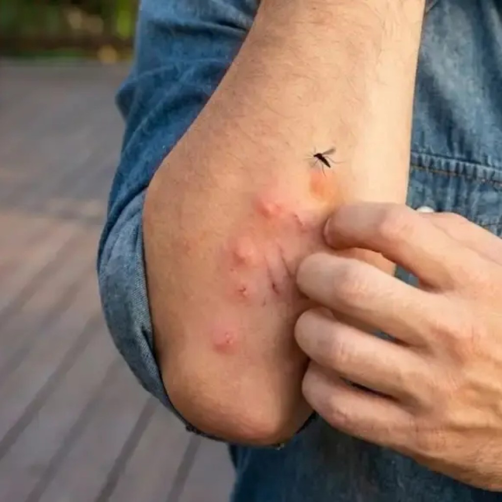 கொசுக்கள் ஏன் உங்களை அதிகம் கடிக்கின்றன: ‘கொசு காந்தமாக’ இருப்பதன் பின்னணியில் உள்ள ஆச்சரியமான அறிவியல் | – டைம்ஸ் ஆஃப் இந்தியா கொசுக்கள் ஏன் உங்களை அதிகம் கடிக்கின்றன: ‘கொசு காந்தமாக’ இருப்பதன் பின்னணியில் உள்ள ஆச்சரியமான அறிவியல் | – டைம்ஸ் ஆஃப் இந்தியா