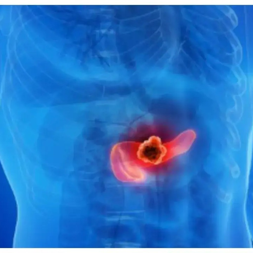 கணைய புற்றுநோய் அறிகுறிகள்: புறக்கணிக்க எளிதான 5 அறிகுறிகள் கணைய புற்றுநோய் அறிகுறிகள்: புறக்கணிக்க எளிதான 5 அறிகுறிகள்